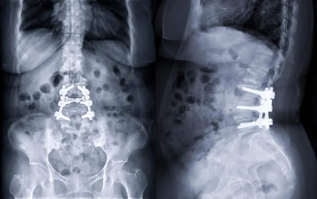Treatment for Spinal Cord Injuries Often Dangerous