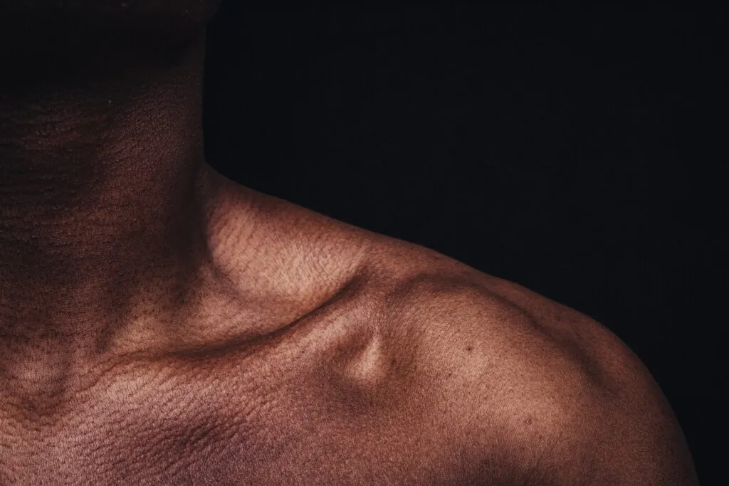 New Jersey Shoulder & Rotator Cuff Injury Lawyers